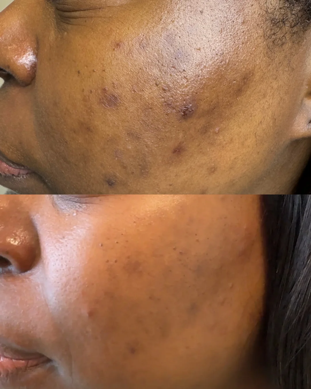 Teen Acne Facial treatment