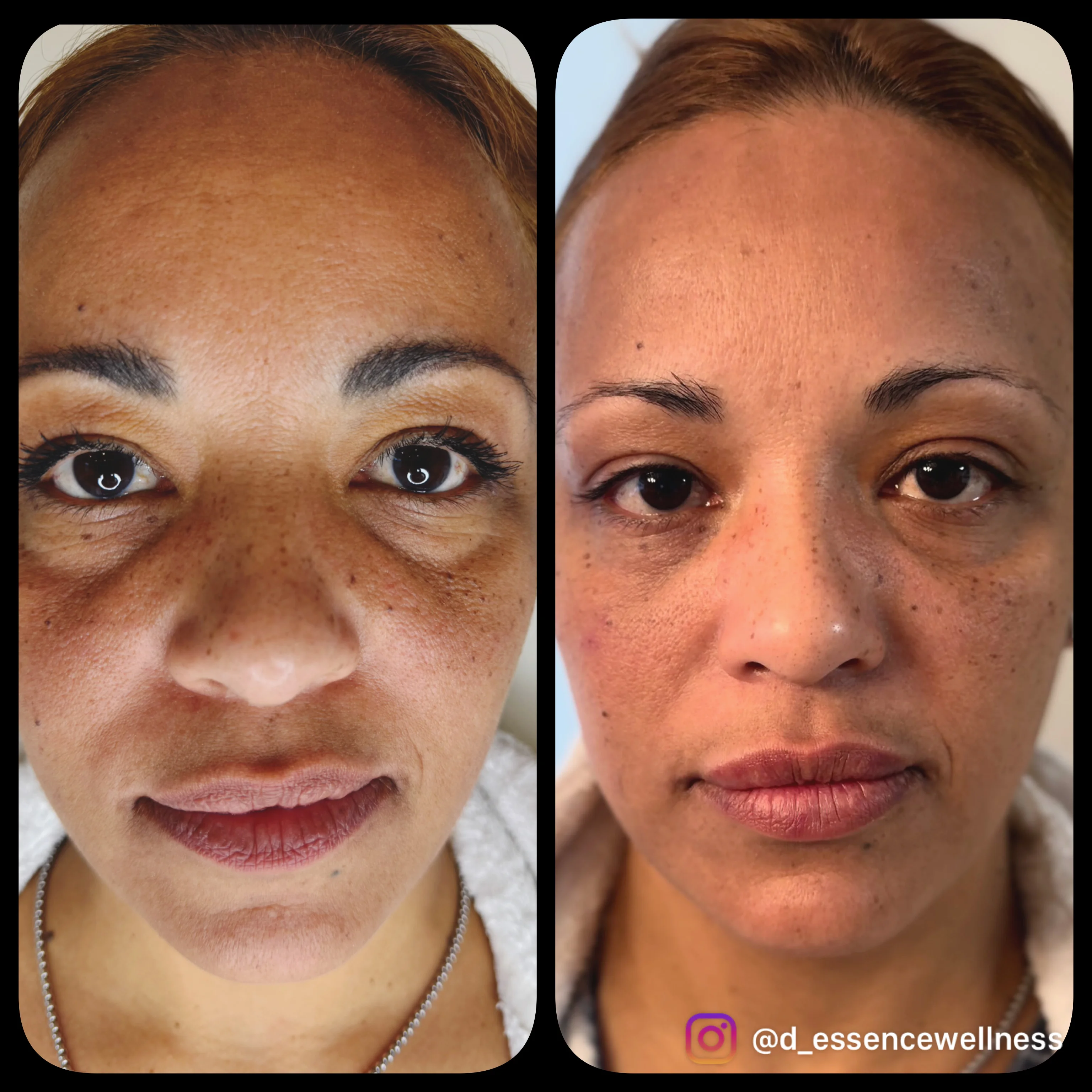 Dermal fillers treatment