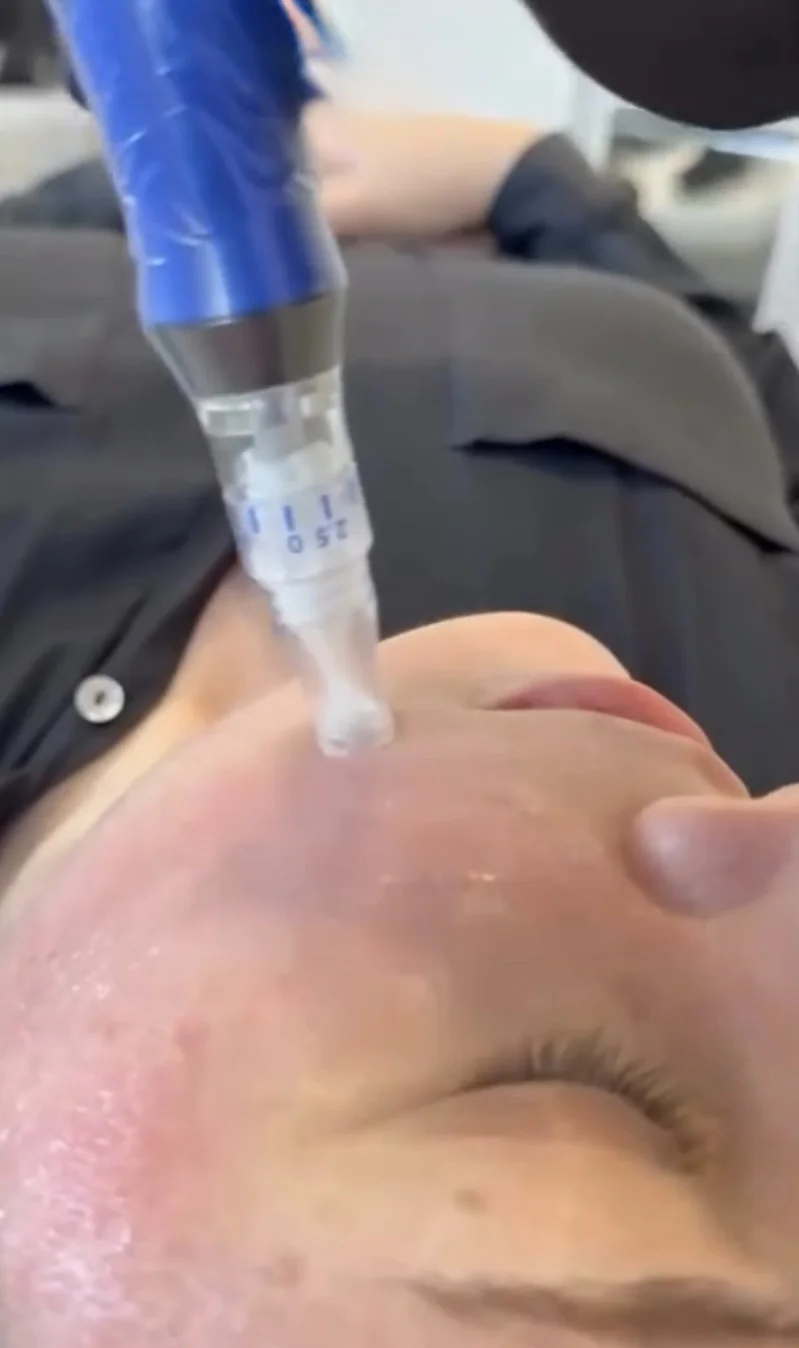 SkinPen microneedling treatment