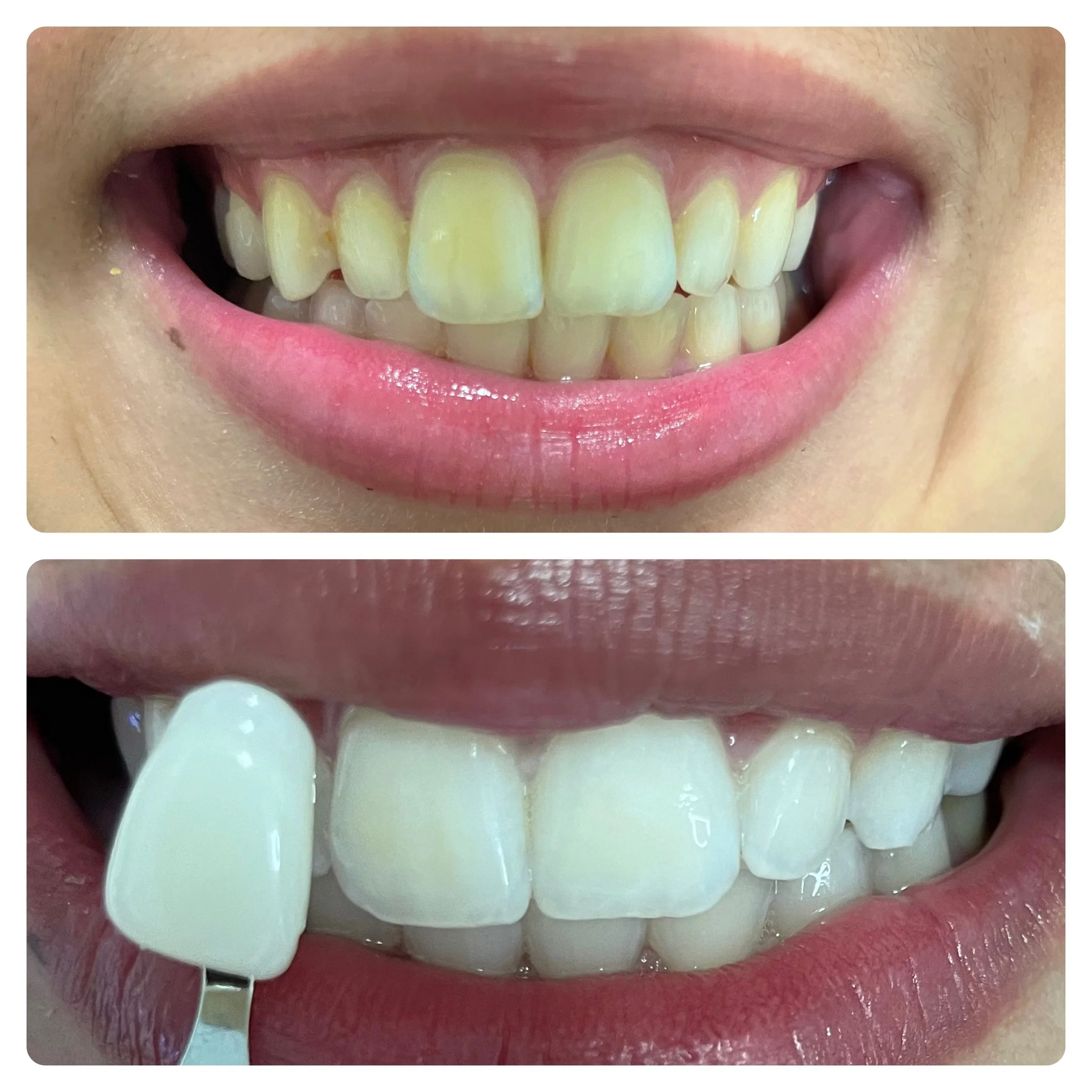 In-office teeth whitening at D-Essence Wellness