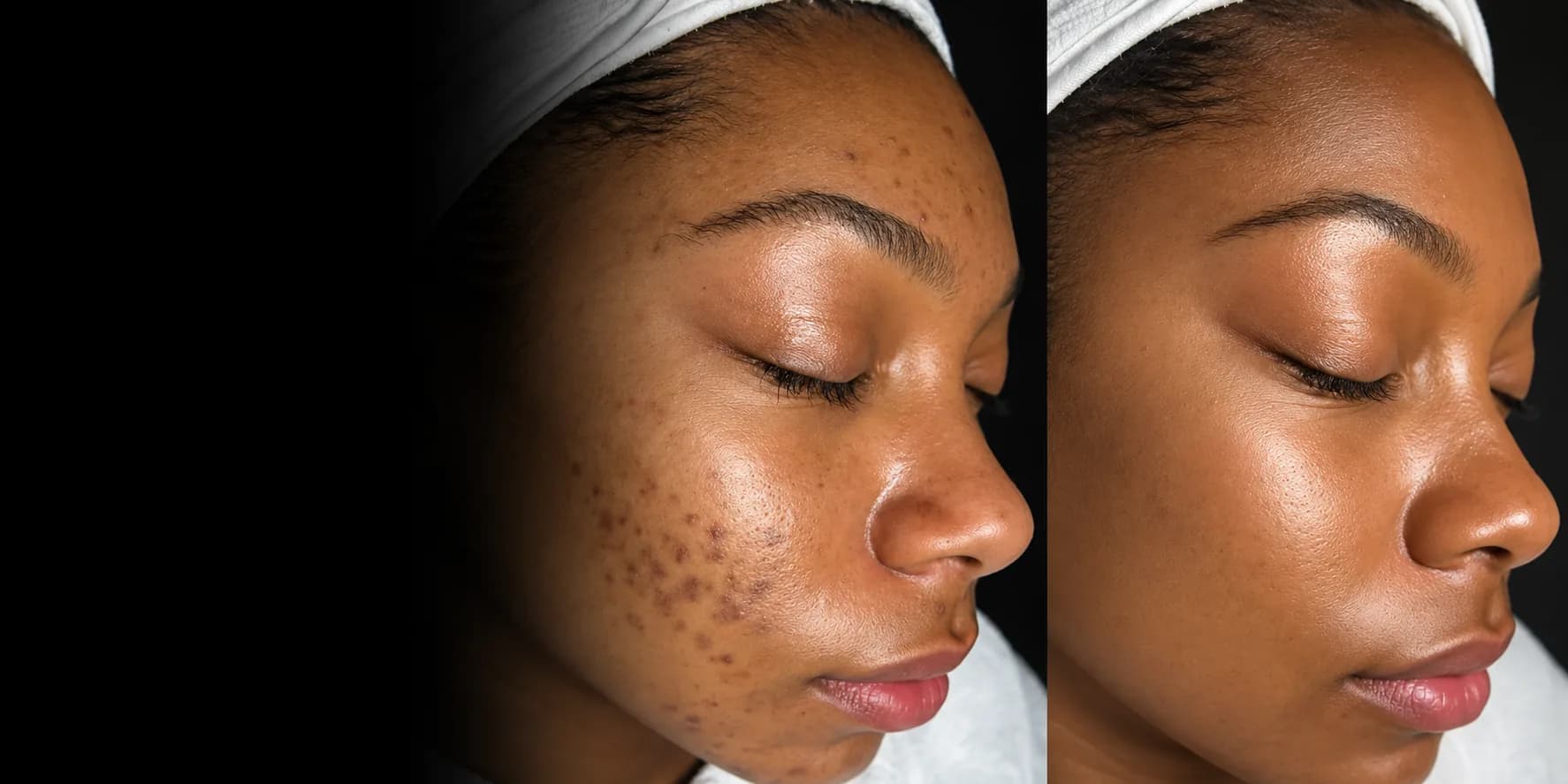 Before and after comparison of a woman in a white headband in profile, with acne marks and dark spots on the left and clear, even skin on the right, fading into black on the left