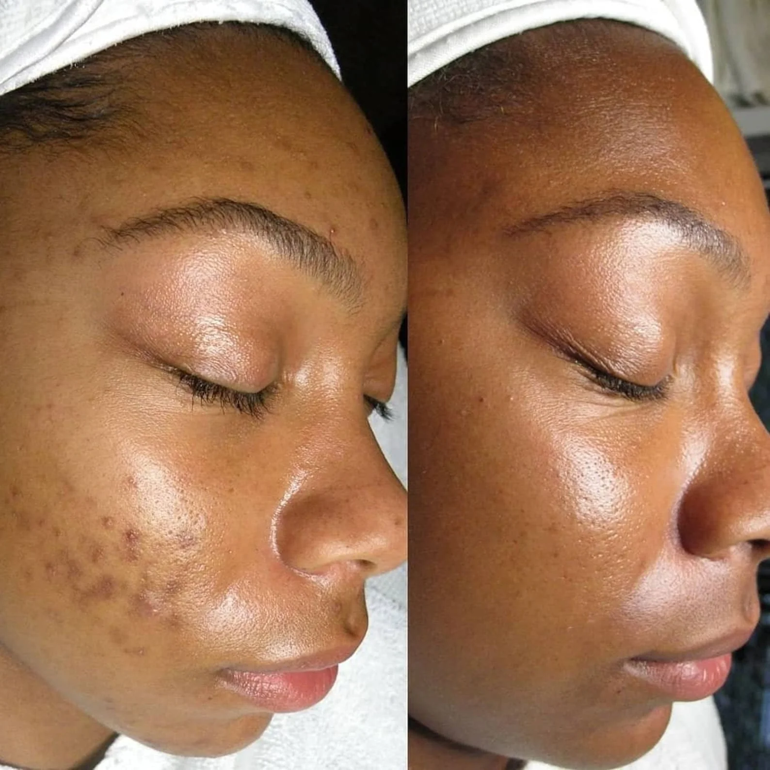 The Perfect Derma Peel treatment at D-Essence Wellness